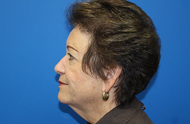 Facelift Before & After Gallery - Patient 200250 - Image 5