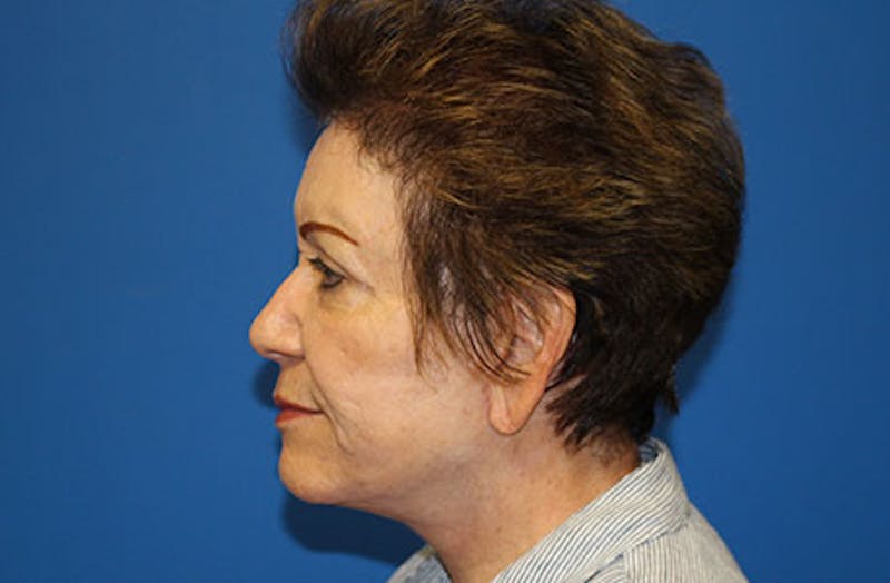 Facelift Before & After Gallery - Patient 200250 - Image 6