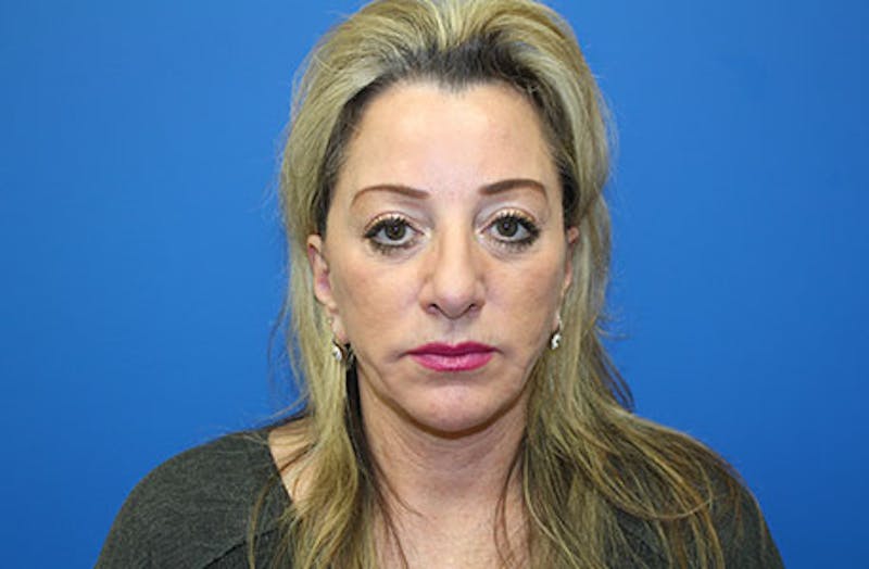 Facelift Before & After Gallery - Patient 202904 - Image 1