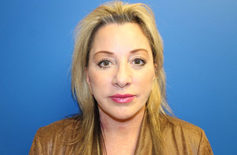 Facelift Before & After Gallery - Patient 202904 - Image 2