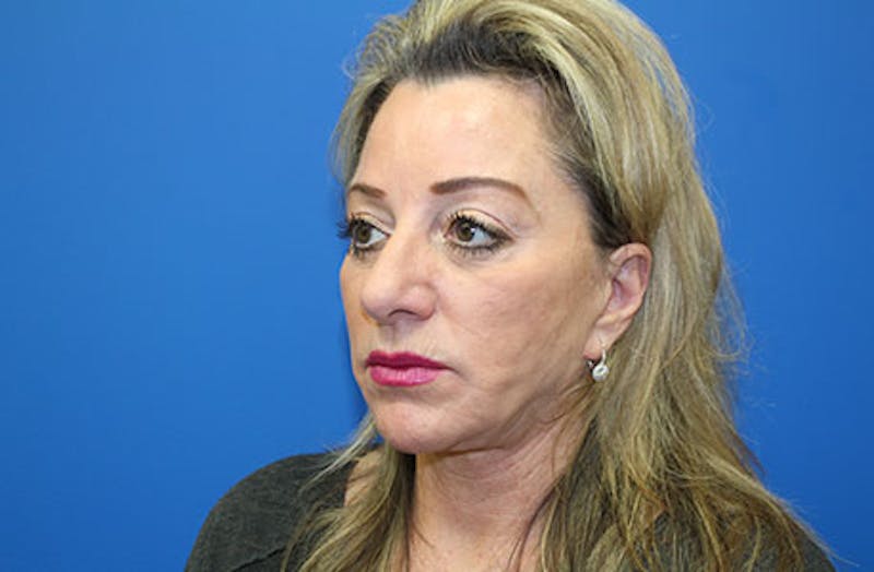 Facelift Before & After Gallery - Patient 202904 - Image 3