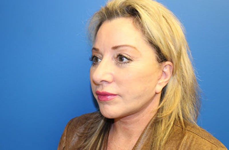 Facelift Before & After Gallery - Patient 202904 - Image 4