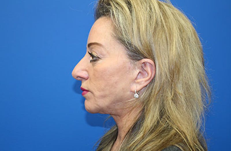 Facelift Before & After Gallery - Patient 202904 - Image 5
