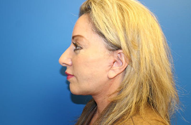 Facelift Before & After Gallery - Patient 202904 - Image 6