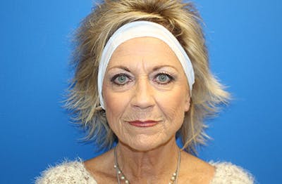 Facelift Before & After Gallery - Patient 260412 - Image 1