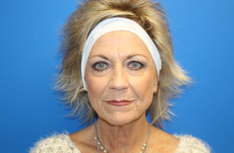 Facelift Before & After Gallery - Patient 260412 - Image 1