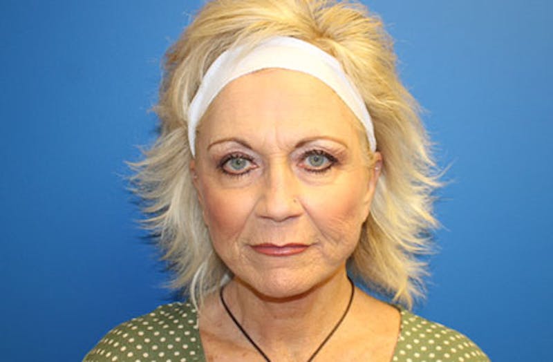 Facelift Before & After Gallery - Patient 260412 - Image 2