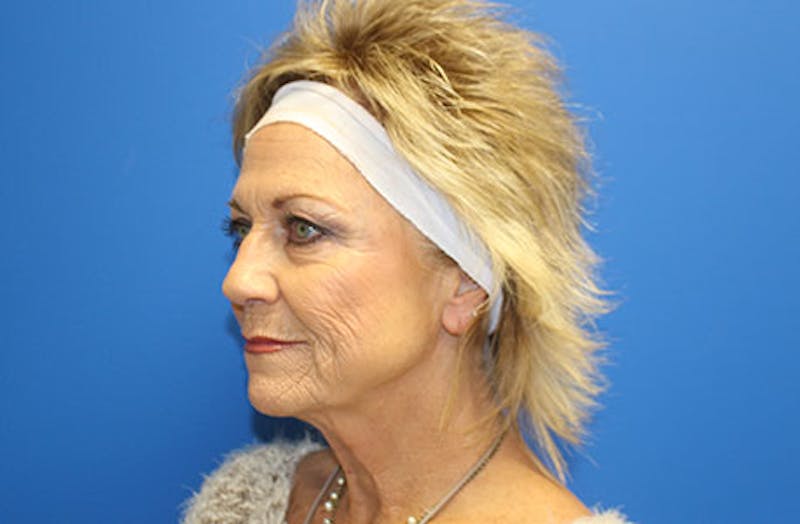 Facelift Before & After Gallery - Patient 260412 - Image 3