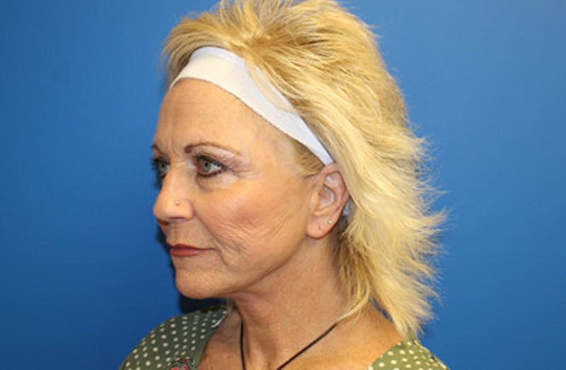 Facelift Before & After Gallery - Patient 260412 - Image 4