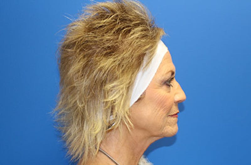 Facelift Before & After Gallery - Patient 260412 - Image 5