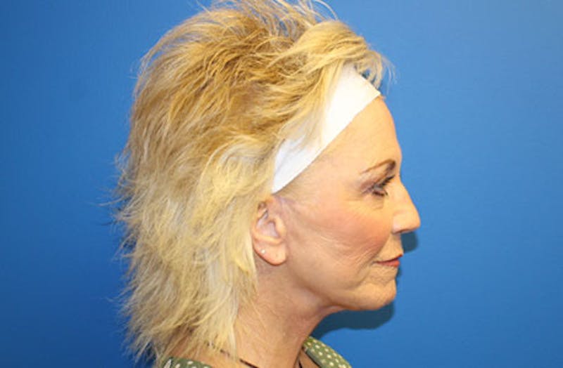 Facelift Before & After Gallery - Patient 260412 - Image 6