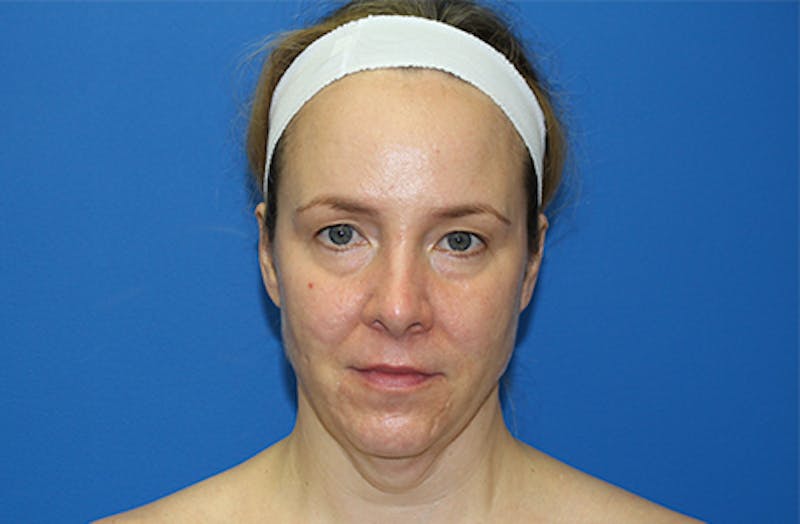 Facelift Before & After Gallery - Patient 378511 - Image 1