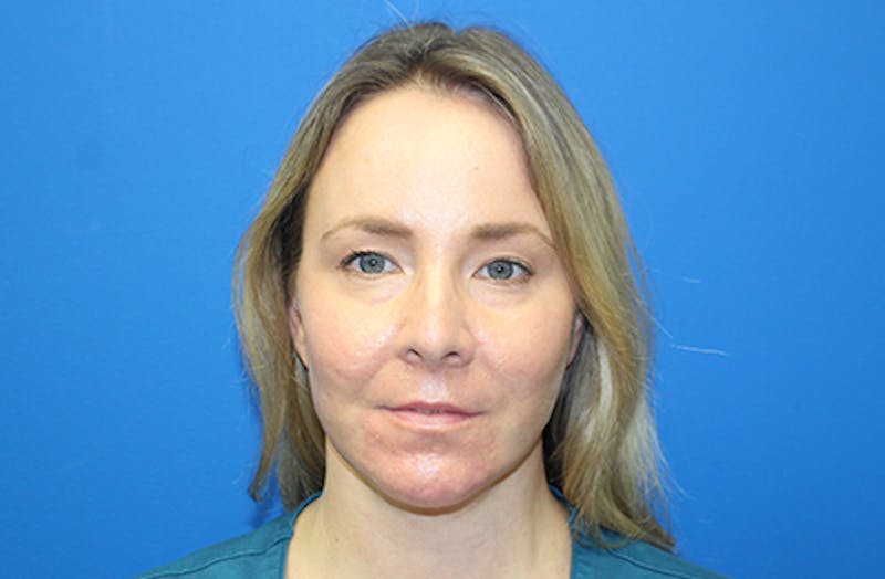 Facelift Before & After Gallery - Patient 378511 - Image 2