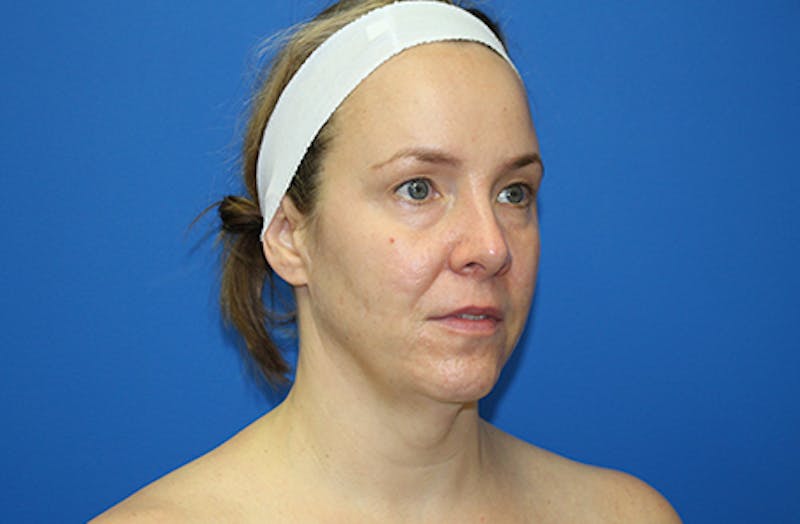 Facelift Before & After Gallery - Patient 378511 - Image 3