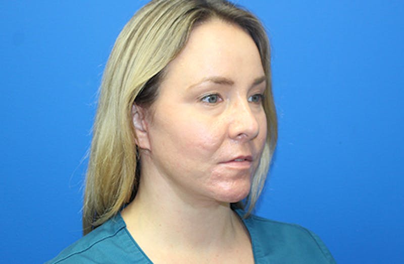 Facelift Before & After Gallery - Patient 378511 - Image 4