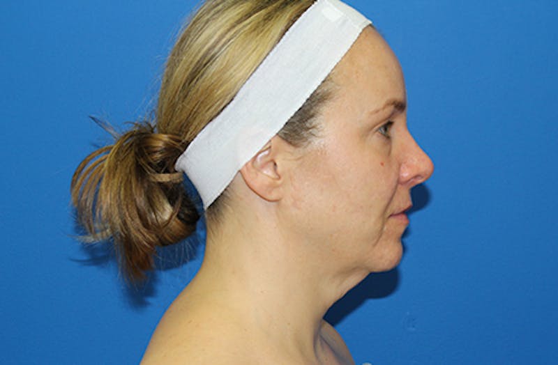 Facelift Before & After Gallery - Patient 378511 - Image 5