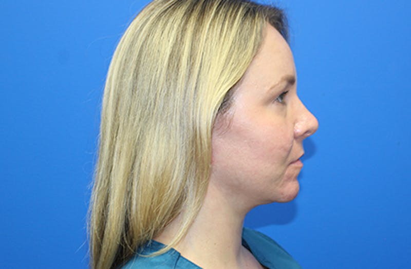 Facelift Before & After Gallery - Patient 378511 - Image 6