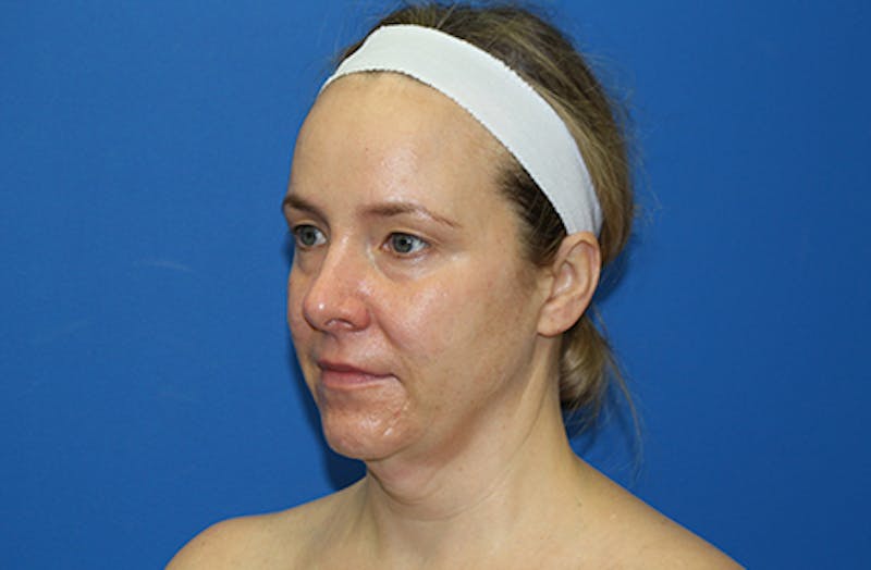 Facelift Before & After Gallery - Patient 378511 - Image 7