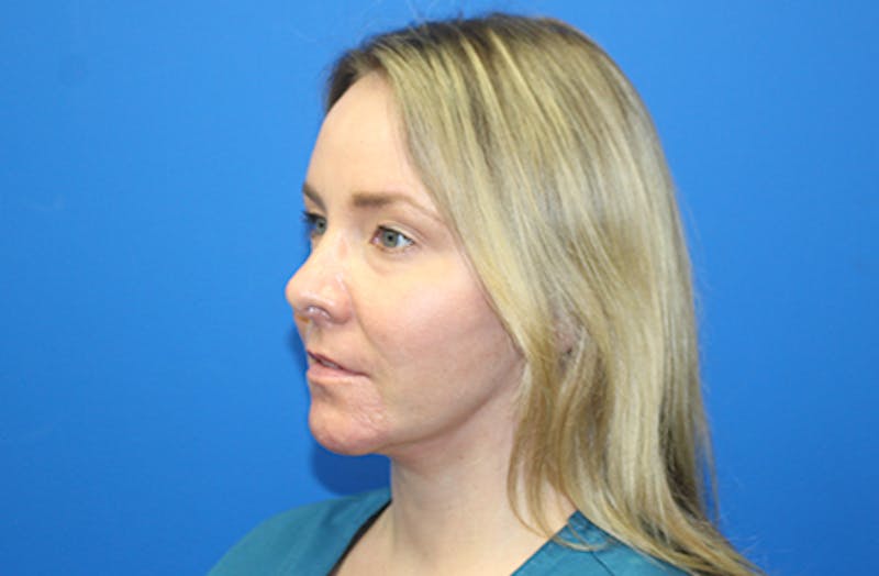 Facelift Before & After Gallery - Patient 378511 - Image 8