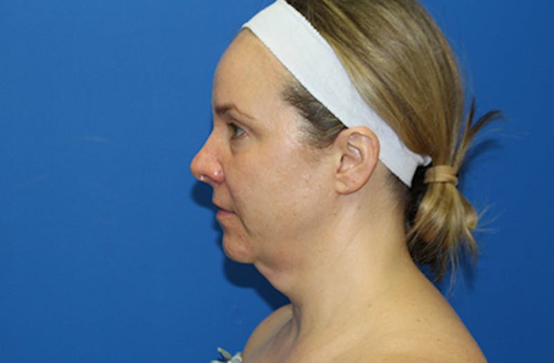 Facelift Before & After Gallery - Patient 378511 - Image 9