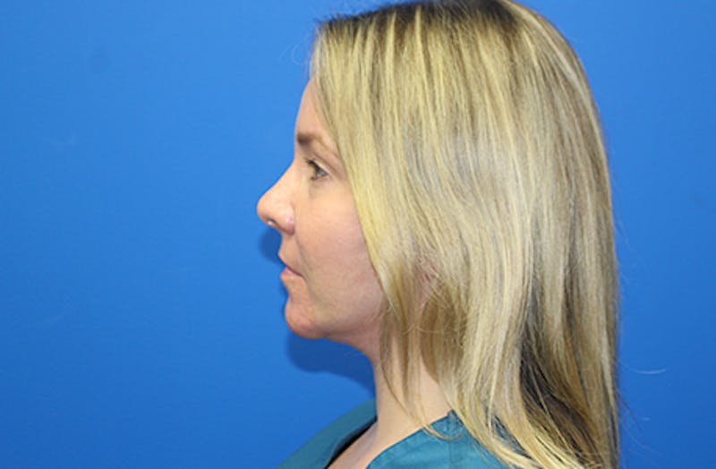 Facelift Before & After Gallery - Patient 378511 - Image 10