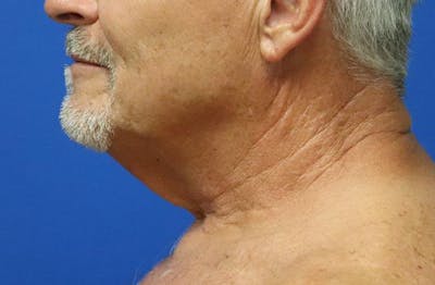 Neck Lift Before & After Gallery - Patient 312978 - Image 1