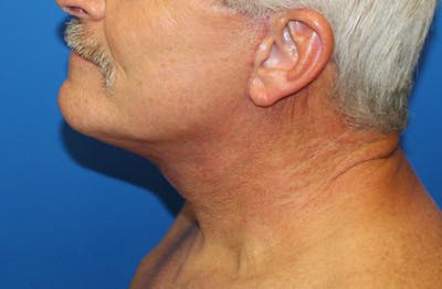 Neck Lift Before & After Gallery - Patient 312978 - Image 2