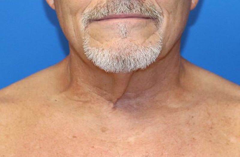Neck Lift Before & After Gallery - Patient 312978 - Image 3
