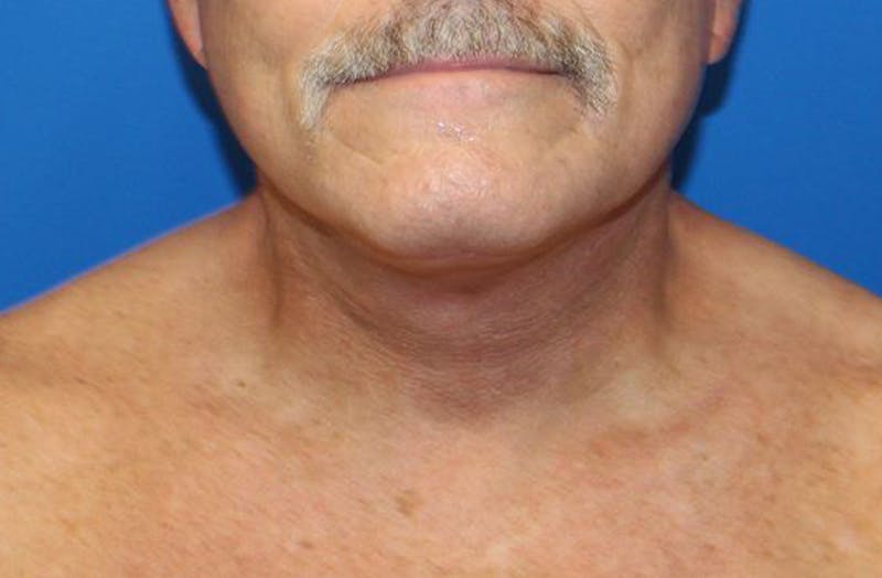 Neck Lift Before & After Gallery - Patient 312978 - Image 4