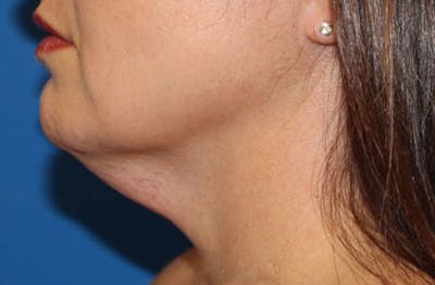 Neck Lift Before & After Gallery - Patient 326738 - Image 1