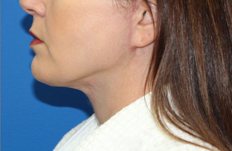 Neck Lift Before & After Gallery - Patient 326738 - Image 2
