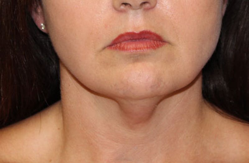 Neck Lift Before & After Gallery - Patient 326738 - Image 3