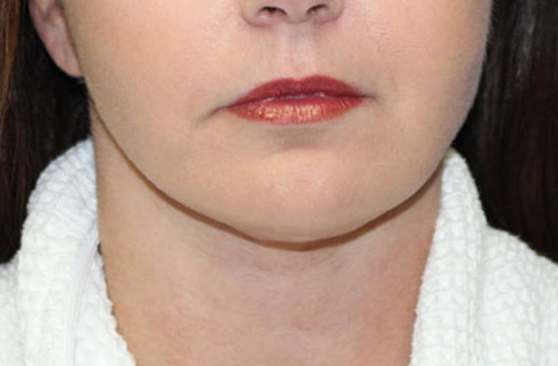 Neck Lift Before & After Gallery - Patient 326738 - Image 4