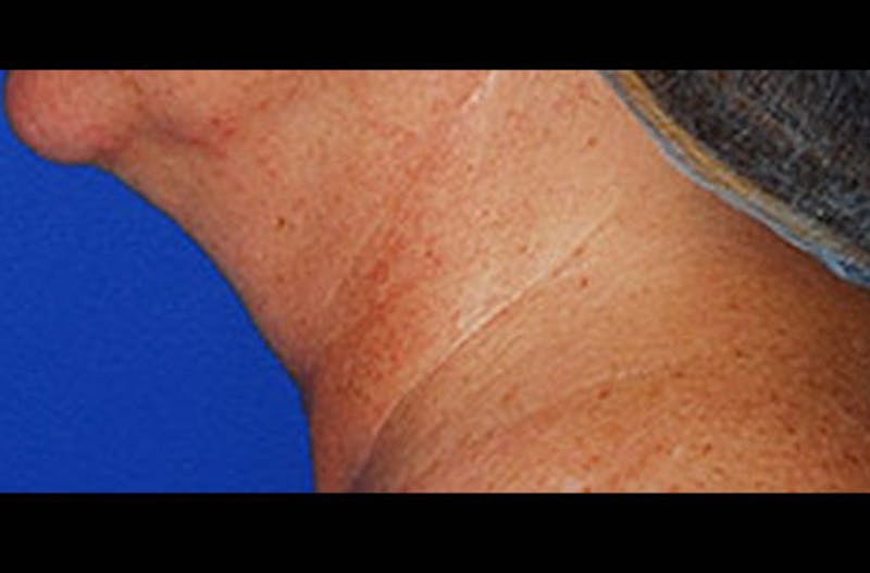 Neck Lift Before & After Gallery - Patient 347808 - Image 1