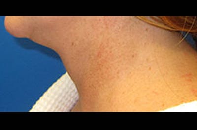 Neck Lift Before & After Gallery - Patient 347808 - Image 2