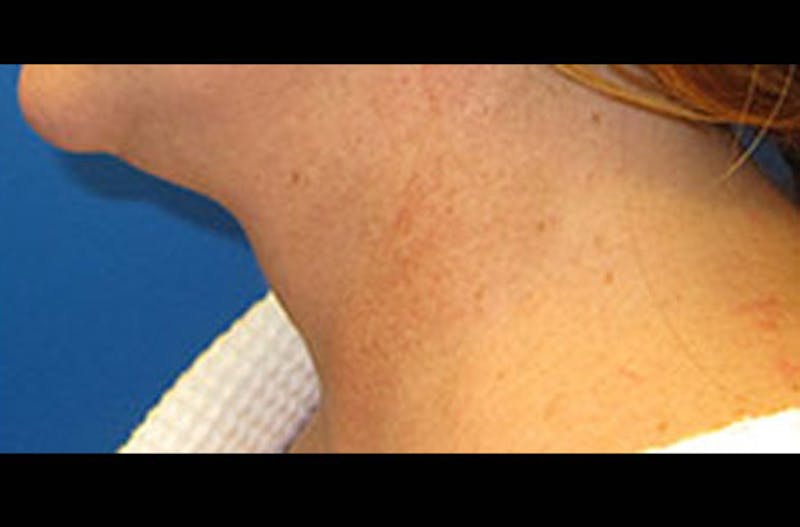Neck Lift Before & After Gallery - Patient 347808 - Image 2