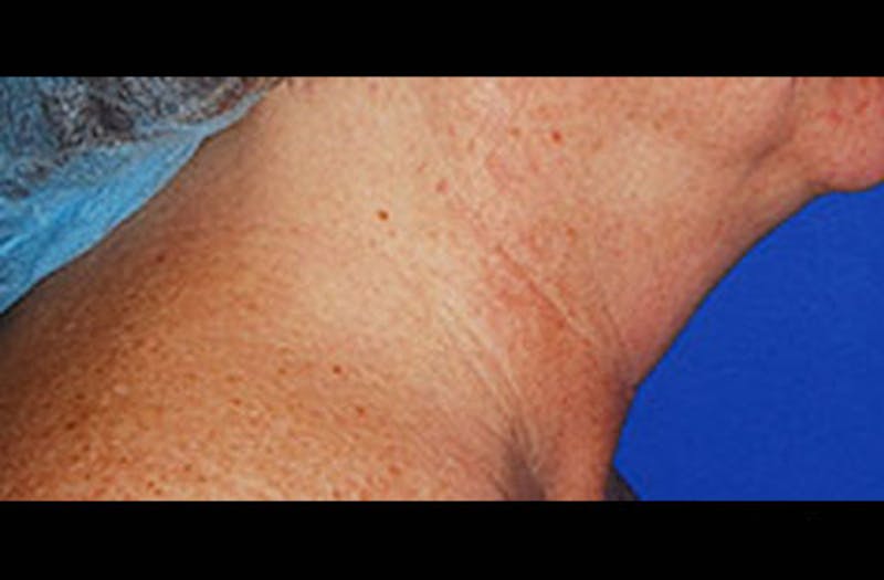 Neck Lift Before & After Gallery - Patient 347808 - Image 3
