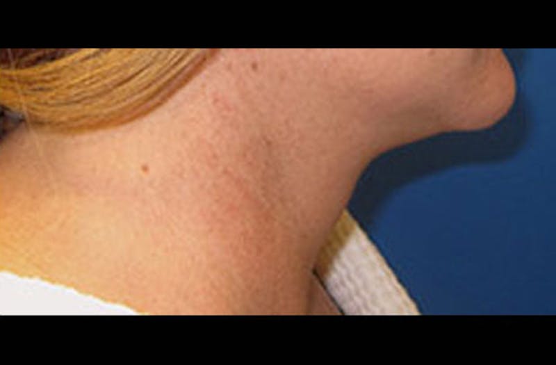 Neck Lift Before & After Gallery - Patient 347808 - Image 4