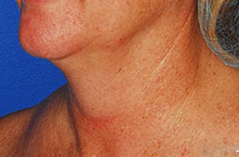 Neck Lift Before & After Gallery - Patient 347808 - Image 5