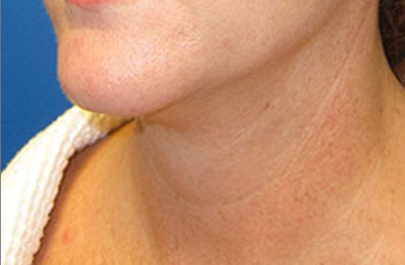 Neck Lift Before & After Gallery - Patient 347808 - Image 6