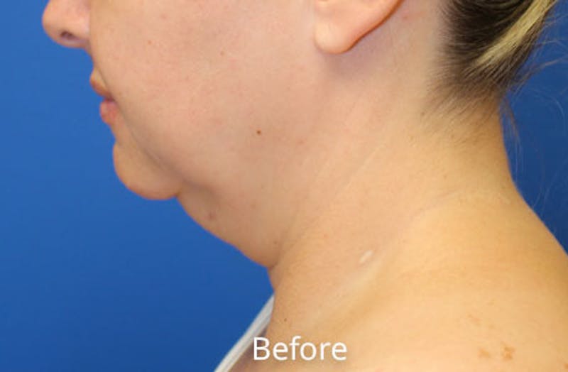 Neck Lift Before & After Gallery - Patient 625453 - Image 1