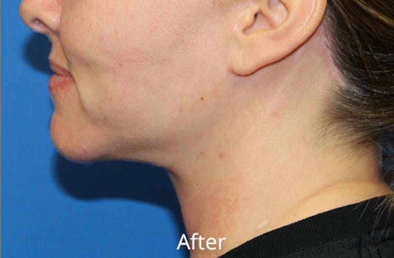 Neck Lift Before & After Gallery - Patient 625453 - Image 2