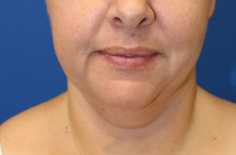 Neck Lift Before & After Gallery - Patient 625453 - Image 3