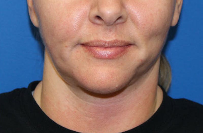 Neck Lift Before & After Gallery - Patient 625453 - Image 4