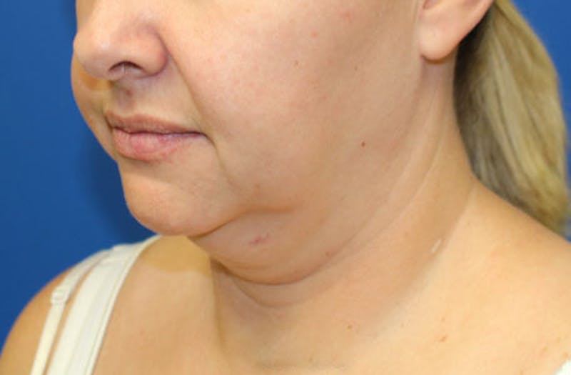 Neck Lift Before & After Gallery - Patient 625453 - Image 5