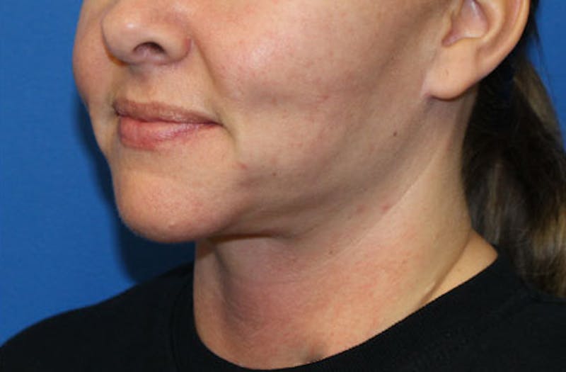 Neck Lift Before & After Gallery - Patient 625453 - Image 6