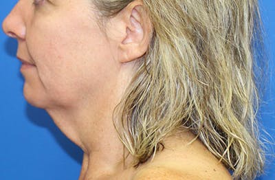 Neck Lift Before & After Gallery - Patient 233759 - Image 1