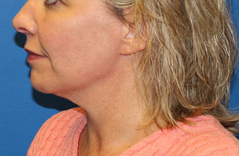 Neck Lift Before & After Gallery - Patient 233759 - Image 2