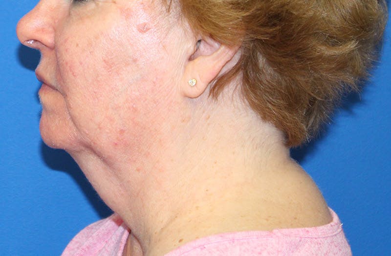 Neck Lift Before & After Gallery - Patient 135194 - Image 1
