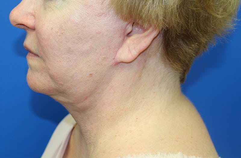 Neck Lift Before & After Gallery - Patient 135194 - Image 2